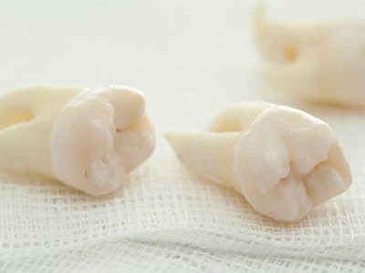 智齒疼了，這牙非拔不可嗎？