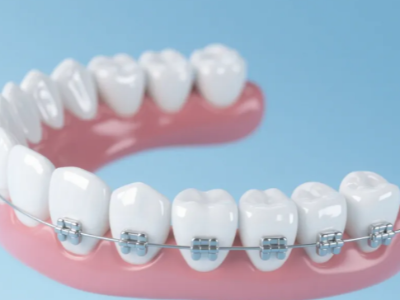 想做牙齒矯正，哪種方案更適合你？