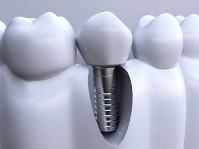 做種植牙全程需要多長(zhǎng)時(shí)間呢?