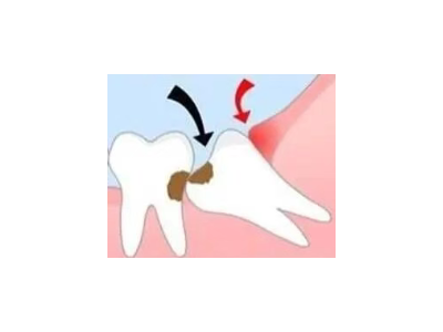 吃完飯后老塞牙？別大意！這可能是你的牙齒在報警