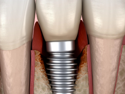 種植牙的術(shù)前準(zhǔn)備有哪些？
