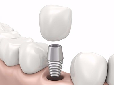 在承德哪家口腔醫(yī)院口腔種植齒好一點，惟德口腔醫(yī)院值得您的選擇