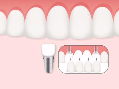 惟德口腔口腔種植怎么樣？惟德口腔就來(lái)為您一一解答