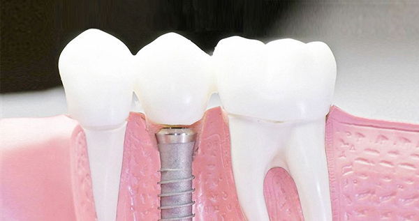 在承德口腔種植牙齒需要多少錢？惟德口腔一一為您道來(lái)
