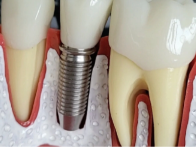 鷹手營(yíng)子缺牙老人：惟德口腔全口種植牙越早做越輕松